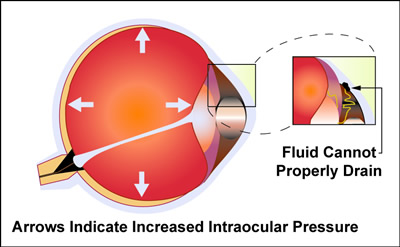 Glaucoma