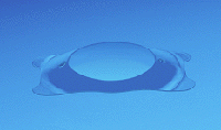 Implantable Collamer Lens